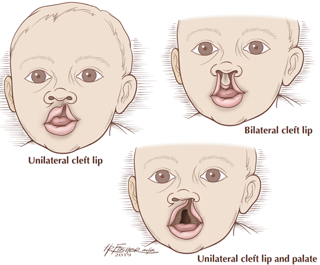 Awareness on Cleft lip and palate