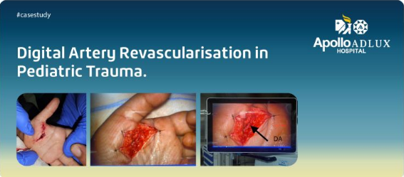 Digital Artery Revascularisation in Pediatric Trauma